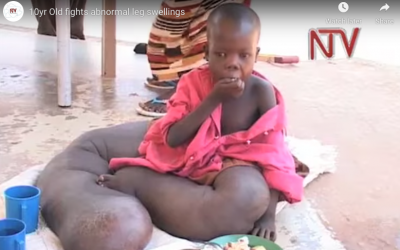 Boy with elephant legs